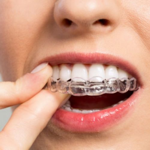 Adult Orthodontics: 7 Things to Know About Invisible Dental Aligners