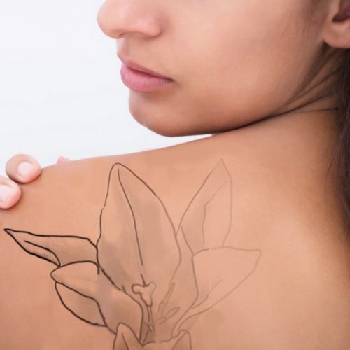 Aesthetic medicine: getting a tattoo removed with laser in 5 questions.