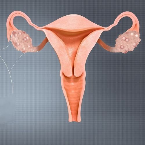 Health: Understanding Polycystic Ovarian Syndrome or PCOS in 6 questions