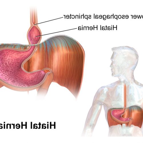 Health: what is a hiatal hernia?